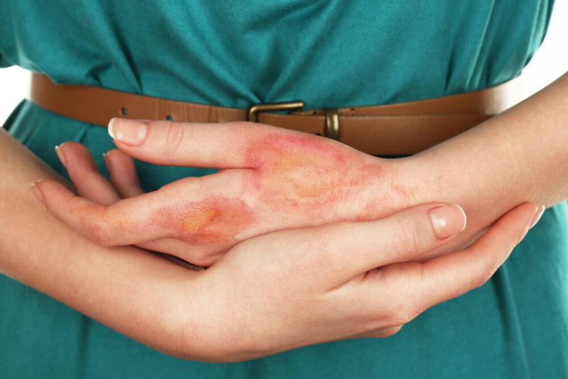 Treatment of Abrasions, Cuts, Wounds, and Burns